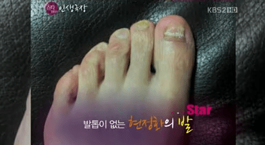 2012년 KBS 2TV '스타 인생극장'에서 공개한 발톱 빠진 발